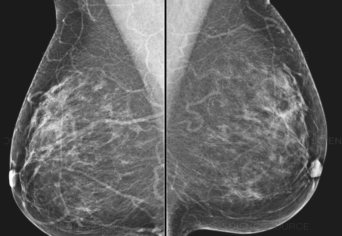 KIS MAGYAR MAMMOGRÁFIA